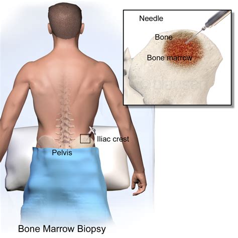 bone marrow biopsy pain afterwards.